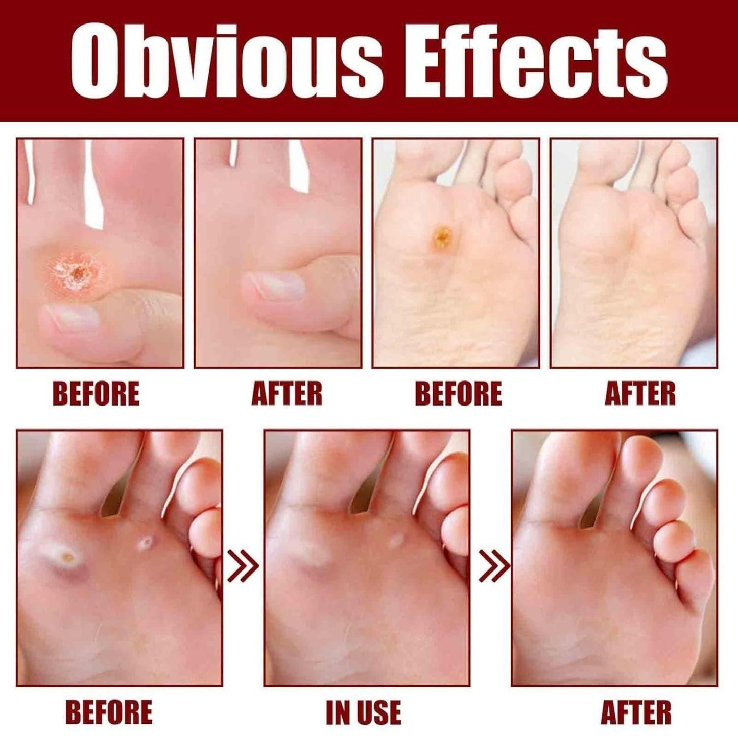 Foot Corn Removal Serum 30ml ( Pack Of 1 )